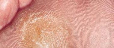plantar callus