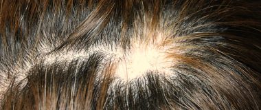 alopecia
