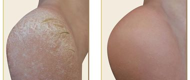 home pedicure for callus ffoot before and after